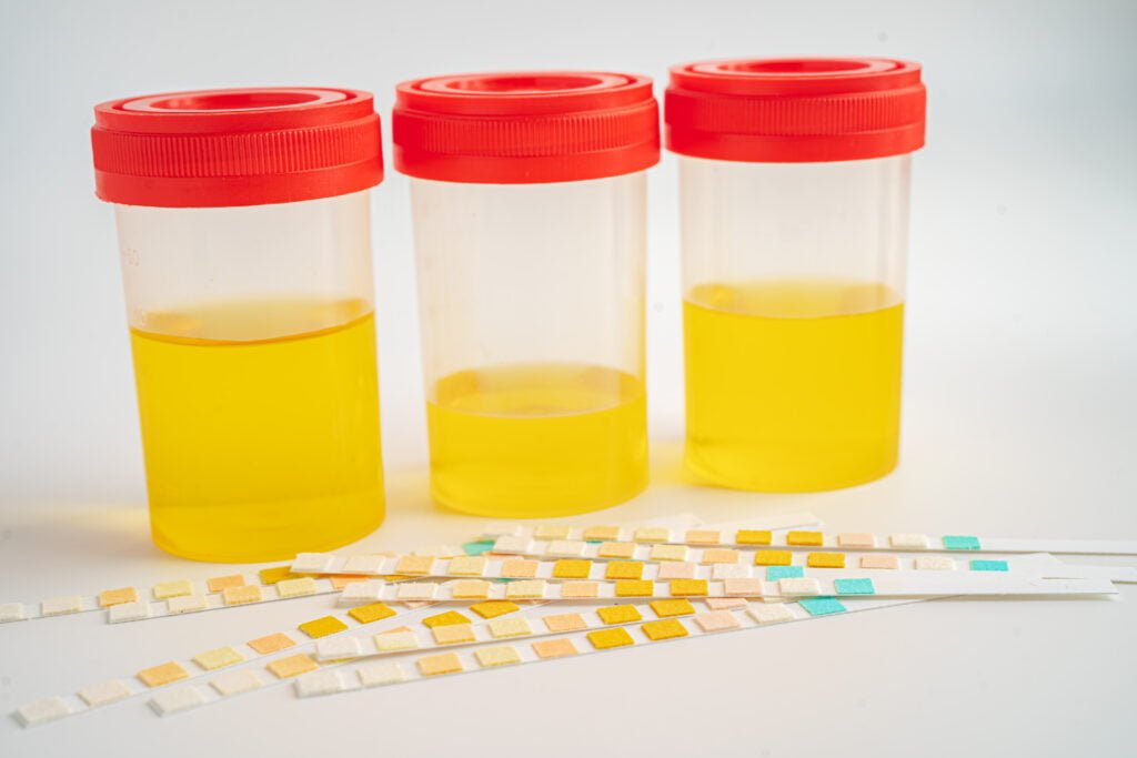 Urinalysis