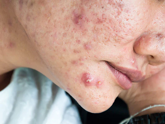 cystic acne melaka