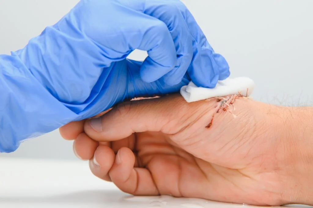 wound care