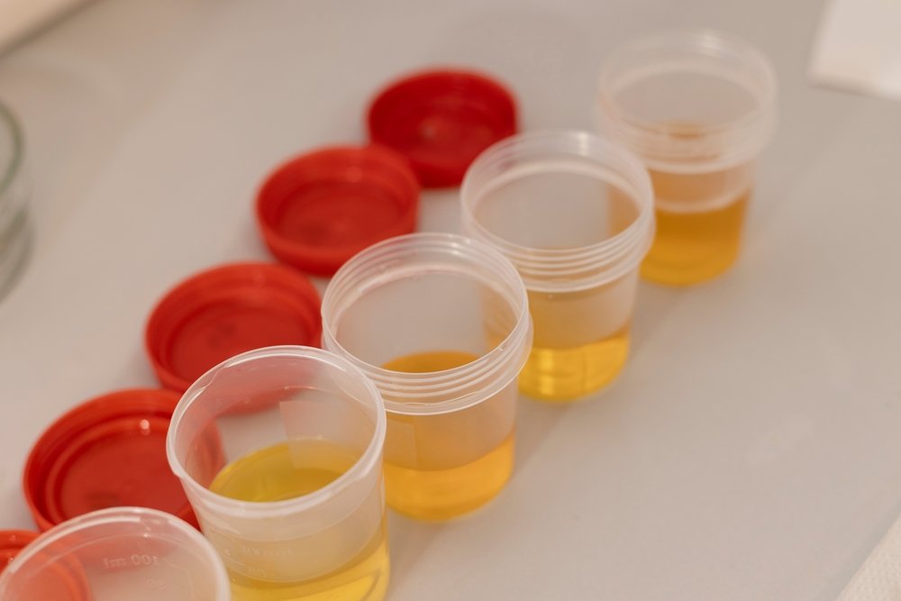 urine samples in various cups for urine test