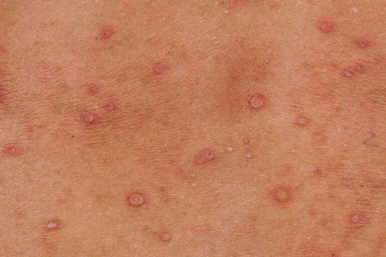 hiv rash on skin ruam hiv