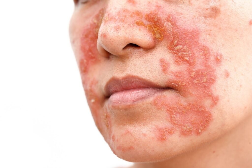 ruam hiv di muka