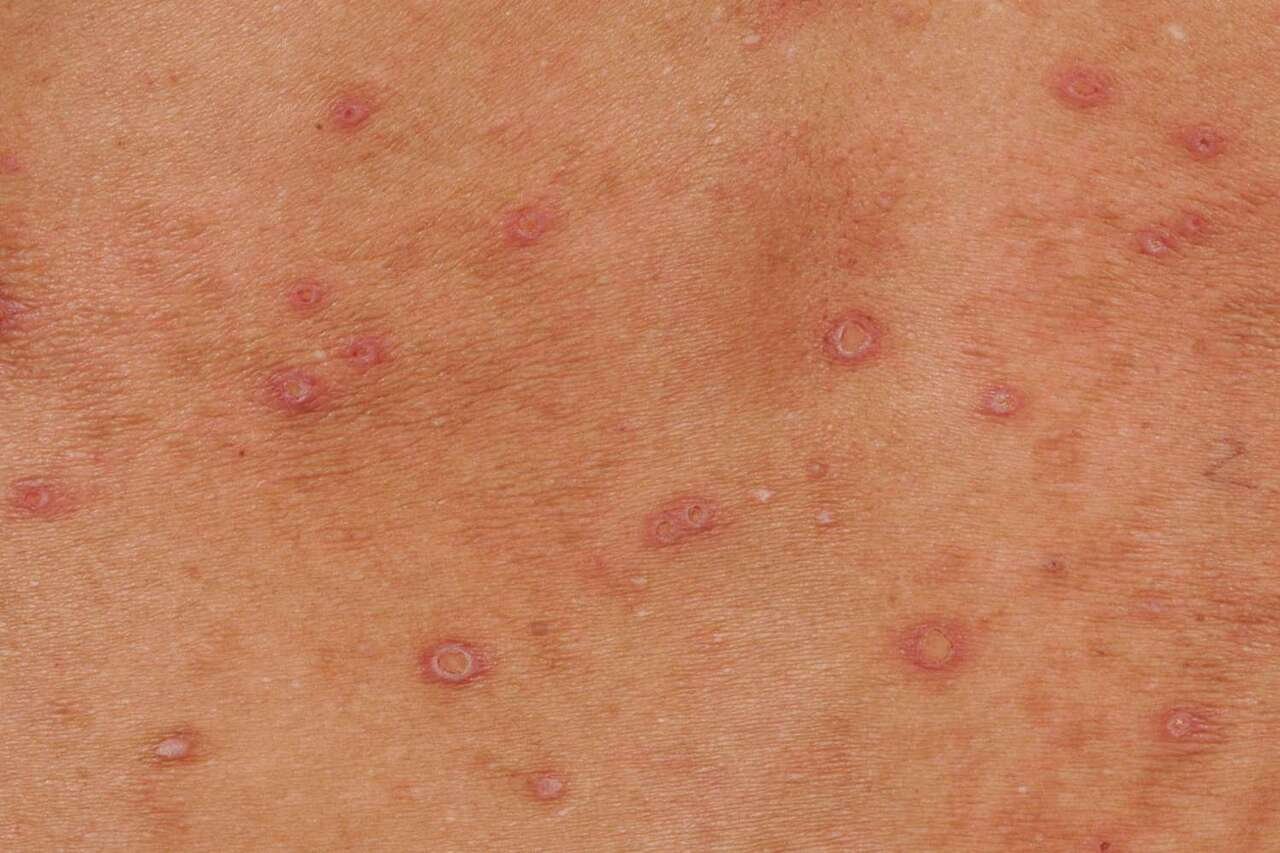 hiv rash on skin ruam hiv